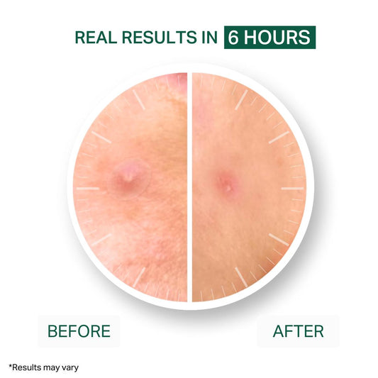 Acne Healing Patches