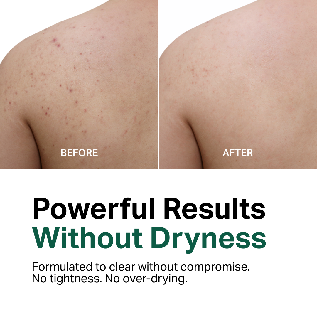 Anti-acne Body Wash